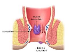Image result for hemoroid human