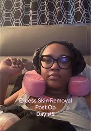 Infraumbilical Panniculectomy with Lipectomy at 220 Pounds