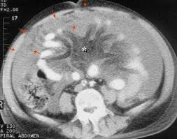 Pin By Hussein Allaw On Ct Radiology Radiology Imaging Gastrointestinal Disorders