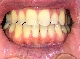 If you don't get the cavity treated, you may start to experience regular pain in the area. I Am Getting Worried About My Receding Gums Should I Be Visiting My Dentist In This Situation I Am Still Young 22 Thanks In Advance Dentistry