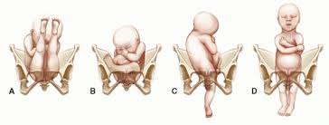 Image result for Breech Delivery