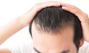 لماذا يتساقط الشعر وما أنواعه dr bayer clinics