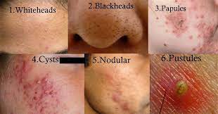 Inflammation of the skin membrane; Facebook