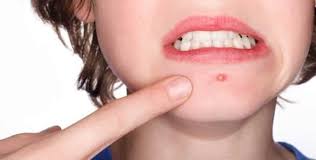 Como Quitar Granos Y Otras Manifestaciones Del Acne