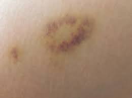 Rapid change in the appearance of one breast, over the course of several weeks thickness, heaviness or visible enlargement of one breast discoloration, giving the breast a red, purple, pink or bruised appearance Yellow Bruise On The Breast Causes Home Remedies And Skin Changes