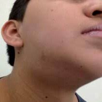 Ultrasonogram of the left submandibular gland, small salivary stone...