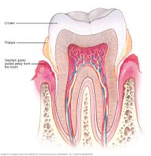 Image result for Periodontitis