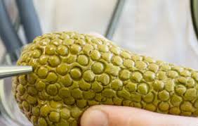 Chiar permite operarea prelungi numai de viață a pacientului, dar nu complet vindecat. Pancreatita Ce O Cauzeaza Si Cum Poate Fi Tratata Aceasta Afectiune Medlife