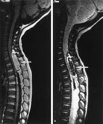 Spontaneous Spinal Epidural Hematoma In Children Pediatric Neurology