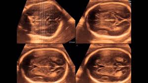Information about scan in the free online tamil dictionary. Detailed Anomaly Scan Youtube