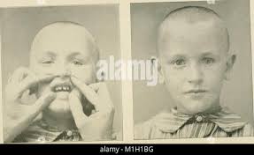 Malattie del naso e della gola; un libro di testo per studenti e  professionisti del settore . Linguetta Vallecula Ary-epiglottic piega  ventricolare destra band apnee spazio sinusale piriforme maggiore corno di  tiroide