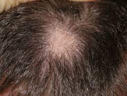 As soon as treatment is administered to scalp psoriasis, lost hair can be regained within a few weeks. Scalp Psoriasis Dermnet Nz