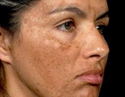 Image result for Melasma