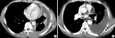 In the usa approximately 1.5 million people are diagnosed with a pleural effusion each year 2. A Initial Chest Computed Tomography Ct Scan Shows Loculated Pleural Download Scientific Diagram