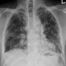 Seorang dengan asbestosis diduga juga lebih berisiko menderita kanker paru di kemudian hari. Pdf Radiologic Diagnosis Of Asbestosis In Korea