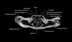 When contracting, this muscle has the characteristic bumps or bulges that are. Chest Anatomy Mri Chest Thorax Axial Anatomy Free Cross Sectional Anatomy