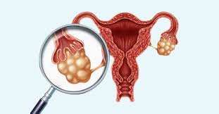 It is the leading cause of death from gynaecological cancer3. Ovarian Cancer Causes Risk Factors Types Stages