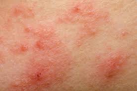 Maybe you would like to learn more about one of these? Neurodermitis Beratung Und Behandlung Von Hautkrankheiten In Bergisch Gladbach