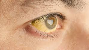 Are there any neurologic symptoms in the chronic form? Yellow Eyes Causes In Newborns Children And Adults