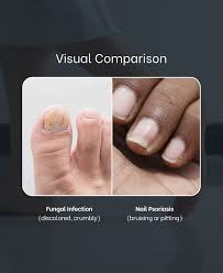 Image result for Pitting nails feet