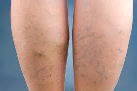 What You Need To Know About Compression Stockings For Varicose Veins
