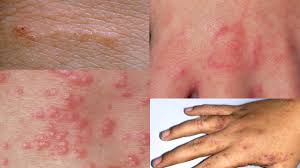 Image result for scabies in the groin area