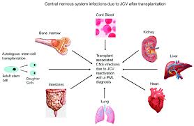 Image result for Transplantation