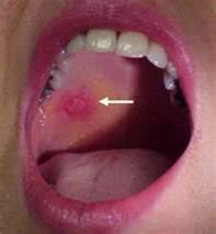 Lupus Mouth Sores Oral Ulcer Mouth Ulcers Mouth Sores