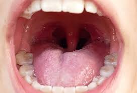 the Roof of Mouth ...