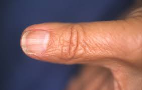 Image result for Glomus tumor