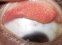 Image result for Vernal Conjunctivitis