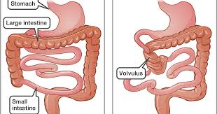 The large intestine consists of the colon, rectum, and anal canal. Congenital Malformations Of The Gastrointestinal Tract
