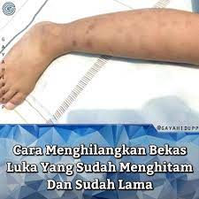 Setiap orang pasti memiliki bekas luka baik di kaki ataupun di tempat lain di tubuh. Cara Menghilangkan Bekas Luka Yang Inspirasi Kesehatan Facebook