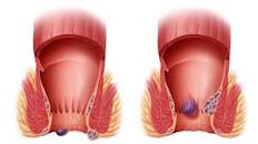Hemorroides, un sufrimiento secreto: peligros, tratamientos ...