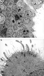 malignant mesothelioma not related to asbestos exposure: The Diagnostic Utility Of Immunohistochemistry And Electron Microscopy In Distinguishing Between Peritoneal Mesotheliomas And Serous Carcinomas A Comparative Study Modern Pathology