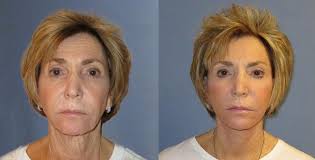 However, choosing a convincing hairstyle can help you to deal with it. How Can I Get Rid Of My Sagging Jowls Brown Plastic Surgery