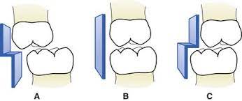 Then a characteristic step is formed. 2 Development Of The Occlusion Pocket Dentistry