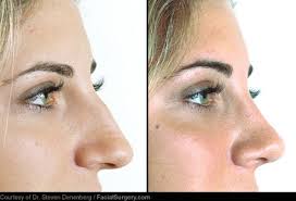 • nose job ( rhinoplasty ) • breast, buttock augmentation / reduction • lips augmentation • chin and face contouring • weight loss, liposuction • muscle. Cosmetic Surgery Before And After Pictures Liposuction Tummy Tuck And More