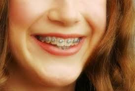 Maybe you would like to learn more about one of these? Gigi Sudah Rapi Tapi Ingin Gaya Pakai Behel Adakah Dampaknya