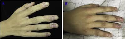 There are many causes, but a mechanical etiology is most common. Efficacy Of The Combination Of Superficial Shaving With Photodynamic Therapy For Recalcitrant Periungual Warts Sciencedirect