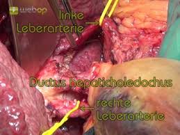 Check spelling or type a new query. Left Lateral Liver Resection Open