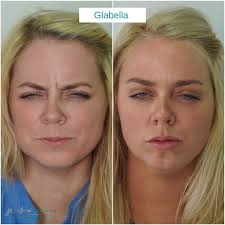 Dysport Before & After (feat. Veazey) You may or may not have seen our  staff Dysport video