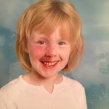 Student says abuse from strangers won't make her cover up birthmark