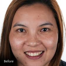 Dr.Ralph Figaroa Delas Alas 🇯🇵🇰🇷🇲🇾🇮🇩🇹🇭🇨🇳🇸🇬🇦🇪🇫🇷🇩🇪  (@dr.rfdsmile) • Instagram photos and videos