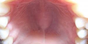 Por Que Se Me Hincha El Labio Superior De Repente Todas Las Causas