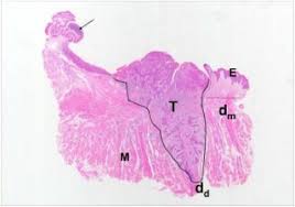 There is not always agreement on how large of a margin is necessary and sometimes it depends on the type of cancer. Surgical Margins In Head And Neck Cancer Intra And Postoperative Considerations Auris Nasus Larynx