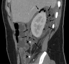 Image result for Perinephric Abscess