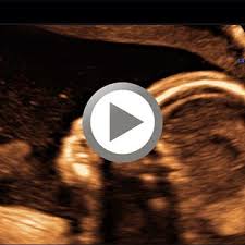 Feinultraschall ist die sonografische untersuchung im rahmen der pränataldiagnostik, also eine untersuchung des ungeborenen kindes, mittels eines besonders hochauflösenden ultraschallgerätes. Praxis Altnowawes Pranataldiagnostik Und Feindiagnostik In Potsdam