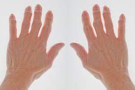 We did not find results for: What Are The 5 Different Types Of Psoriatic Arthritis