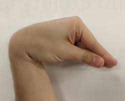 Chvostek's and trousseau's signs e un video con un esmpio. Trousseau Sign Of Latent Tetany Wikipedia